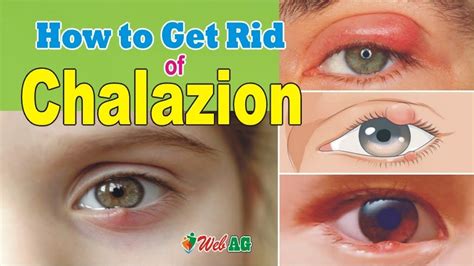 chalazion and apple cider vinegar|chalazion treatment without surgery.